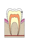 dental cavity 2