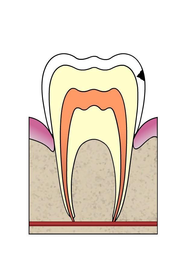 Image dental cavity 2